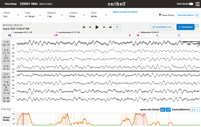 Ceribell brings power of AI to seizure management