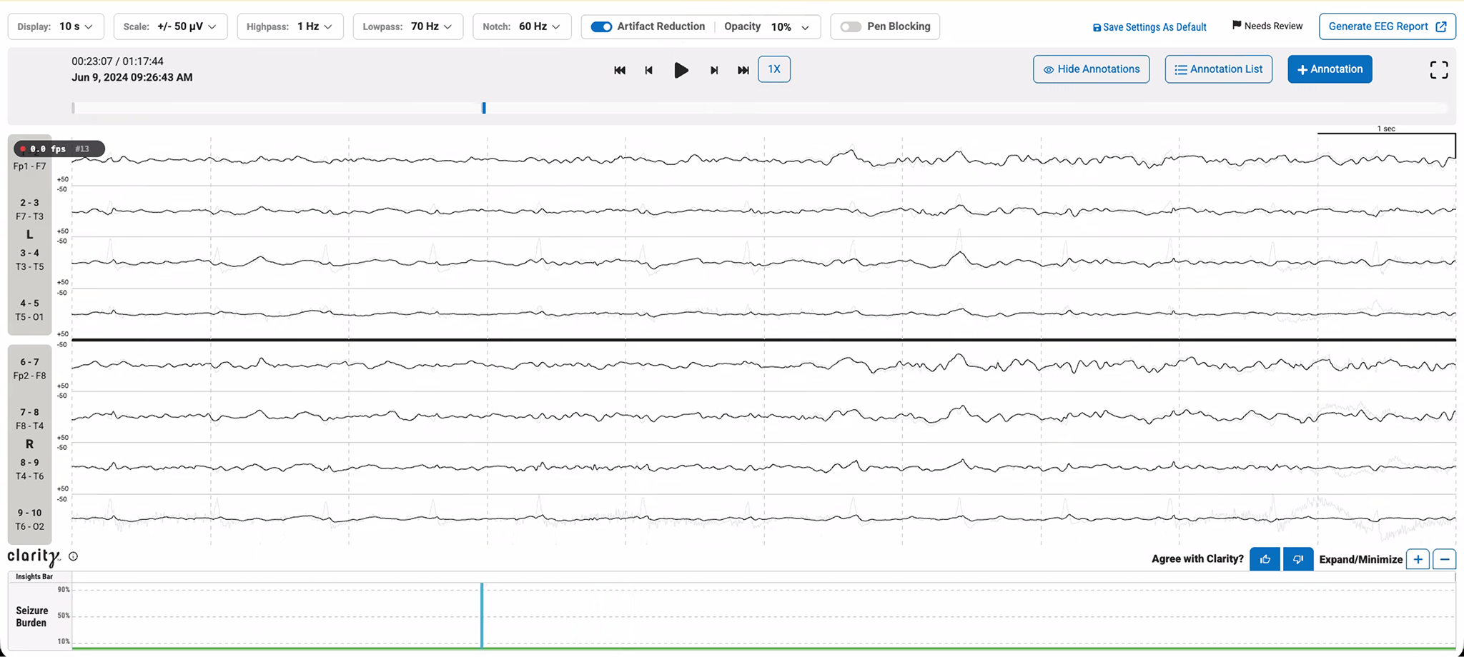 EEG with artifact reduction on — clean waveform