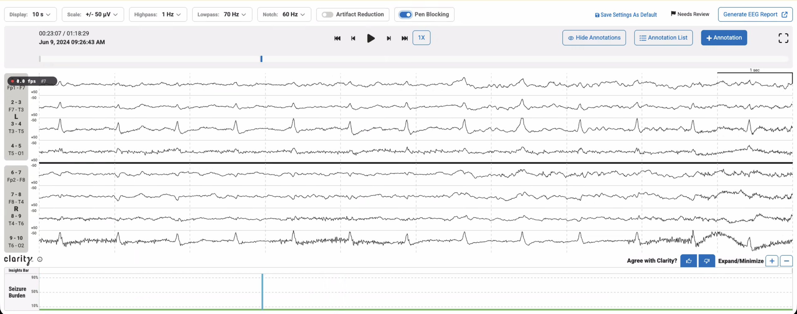 EEG with artifact reduction off — raw waveform